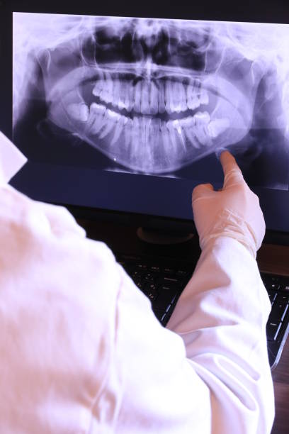 Best Emergency Wisdom Tooth Extraction in Hamton, IL