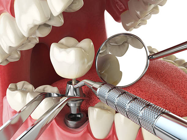 Best Broken or Chipped Tooth Repair in Hamton, IL